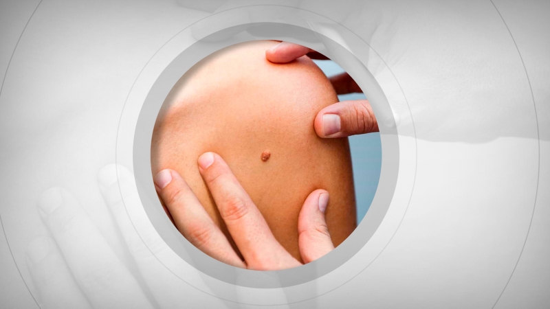 SBOC defende equidade na incorpora&ccedil;&atilde;o de imunoterapia contra melanoma no SUS