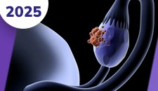 Ovário: tumores epiteliais