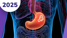 Carcinomas neuroendócrinos extrapulmonares